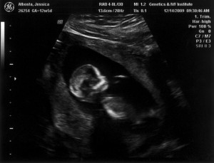 13 Week Sonogram